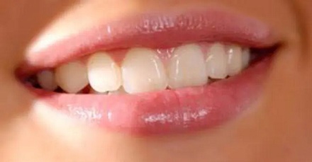 健康的牙齿应该是什么颜色？