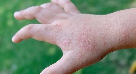 湿疹都是因为环境潮湿引发的吗？
