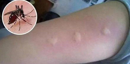 什么被蚊子咬了之后会越抓越痒呢？