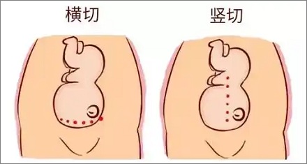 为啥剖腹产要用手撕成大口，而不是用刀切开？