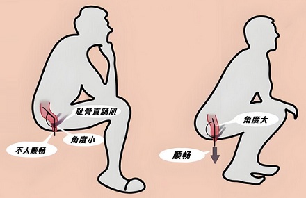 为什么建议蹲着上厕所?