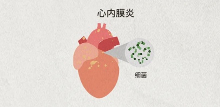 为什么做心脏手术前要先洗牙？