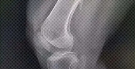 为什么医生会让骨折的病人等几天再手术？