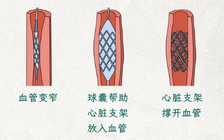 明明是做心脏支架手术，为什么却要在手腕上开一刀？