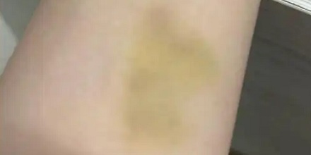 身上的淤青变成黄色，是快痊愈了还是更严重了？