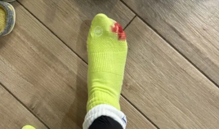 为什么有些马拉松运动员要拔掉自己的脚指甲？