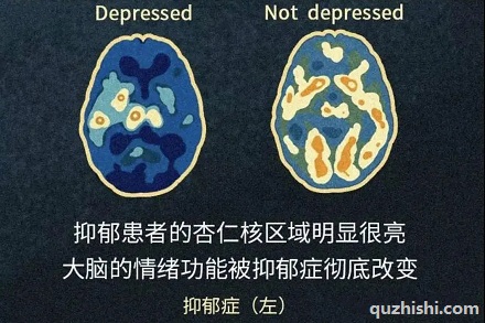 为啥抑郁症患者会有更多的「负面情绪」？